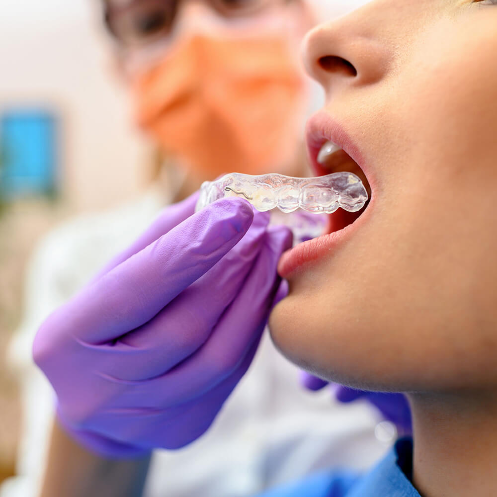 OrthoFX Clear Aligners