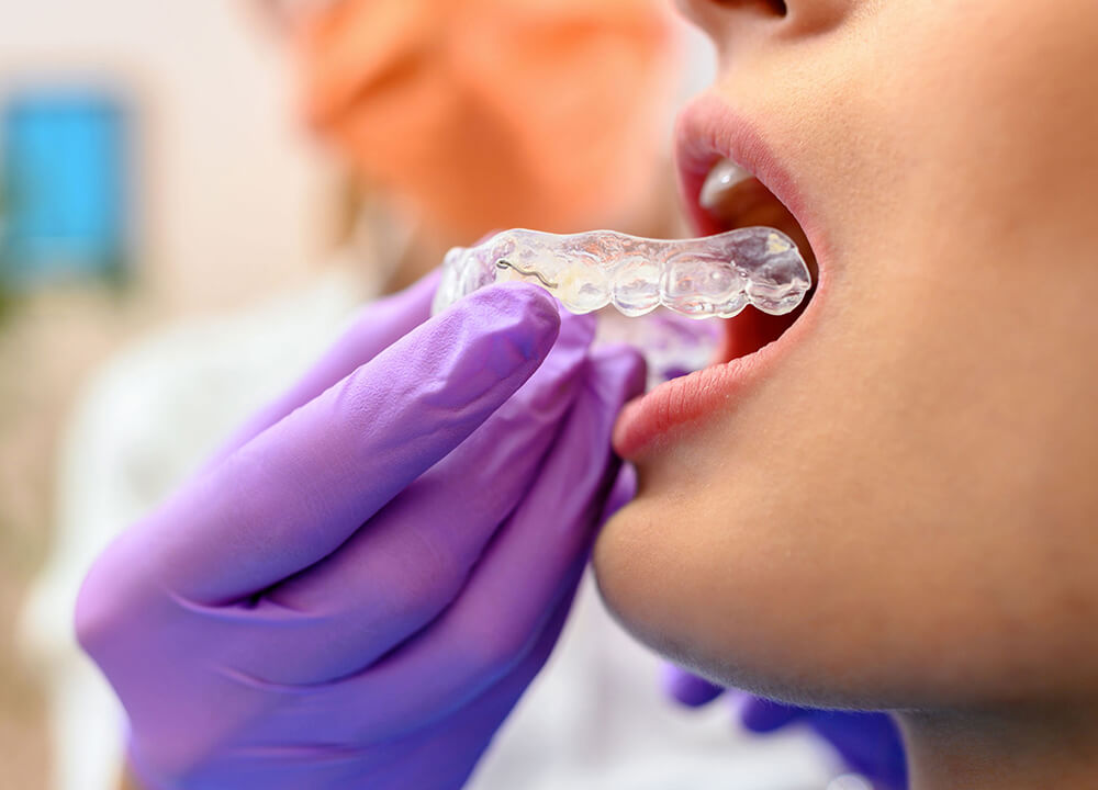 Clear Aligners for Teens